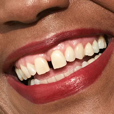 Chowdhury's Premium Dental Closing gap between teeth 3