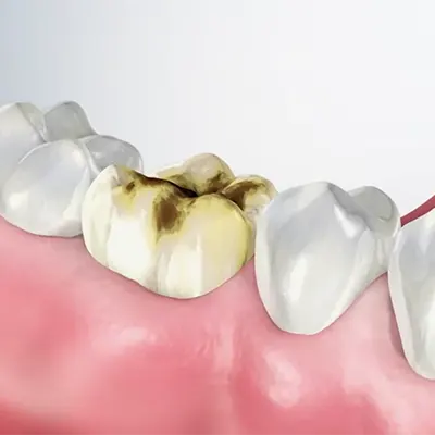Chowdhury's Premium Dental Dental Crown 1