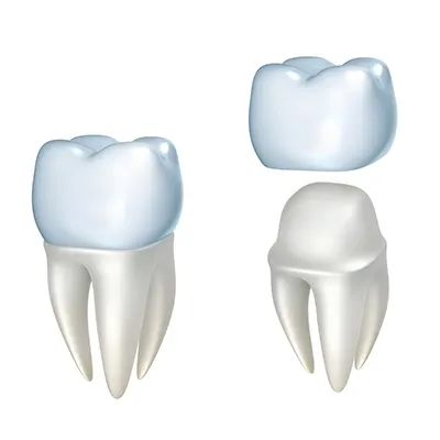 Chowdhury's Premium Dental Dental Crown 3