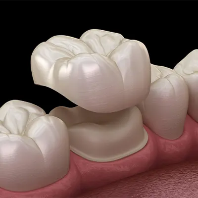 Chowdhury's Premium Dental Dental Crown 5