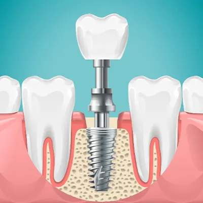 Chowdhury's Premium Dental Dental Implant 1