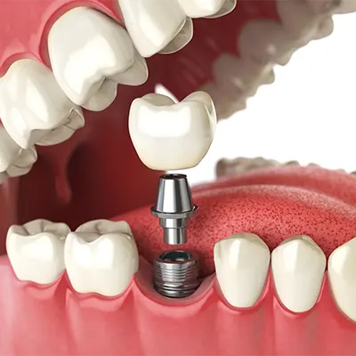 Chowdhury's Premium Dental Dental Implant 2