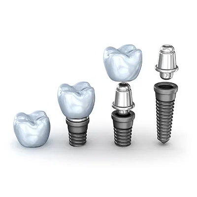 Chowdhury's Premium Dental Dental Implant 3