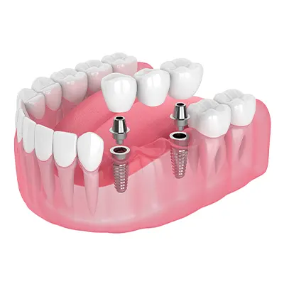 Chowdhury's Premium Dental Dental Implant 4