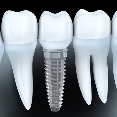Chowdhury's Premium Dental Dental Implant 5