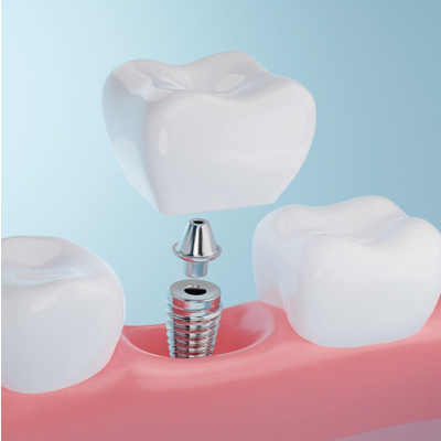 Chowdhury's Premium Dental Dental Implant slider 1