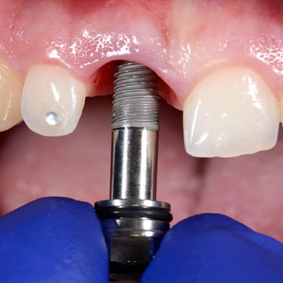 Chowdhury's-Premium-Dental-Dental-Implant-slider-2