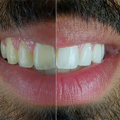 Chowdhury's Premium Dental Tooth Whitening 2