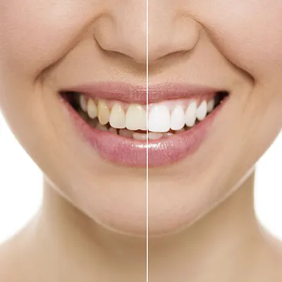 Chowdhury's Premium Dental Tooth Whitening 4